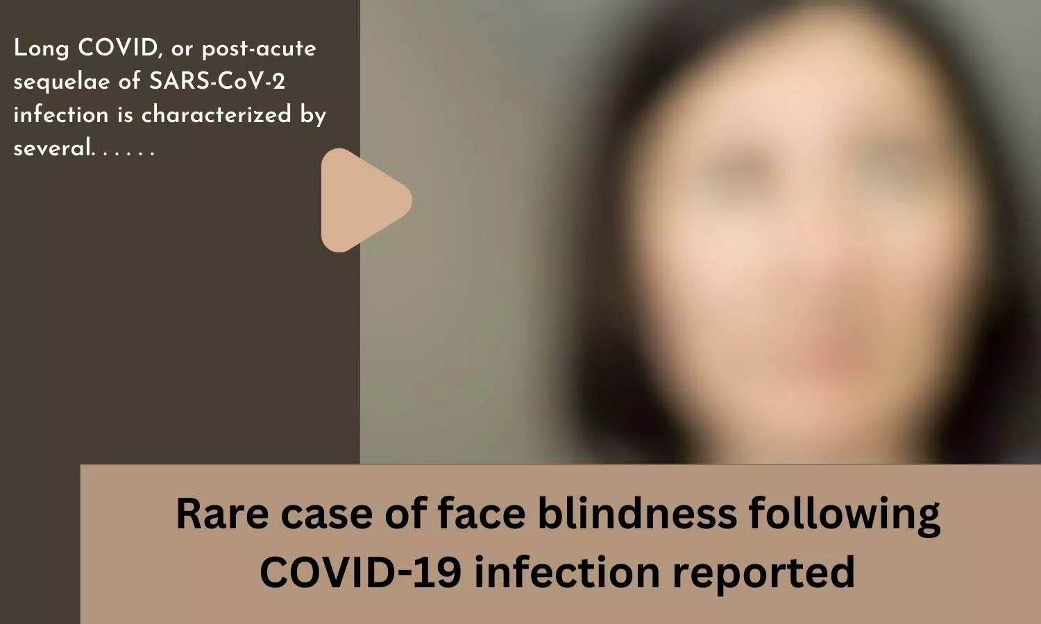 Rare case of face blindness following COVID-19 infection reported