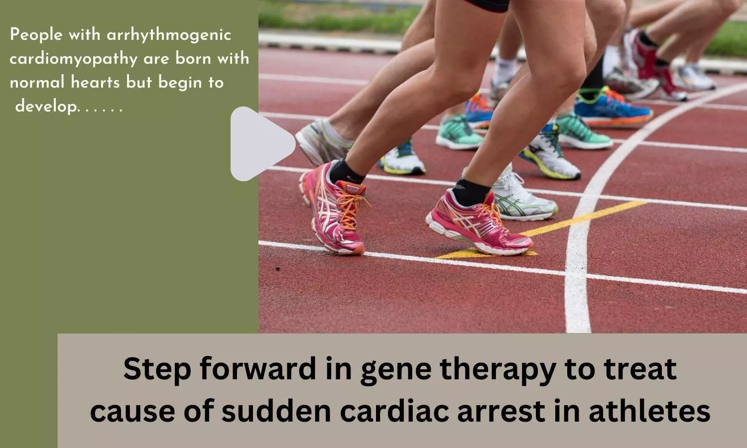 Step forward in gene therapy to treat cause of sudden cardiac arrest in athletes