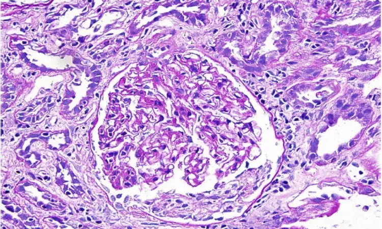 Immune checkpoint inhibitors linked granulomatous small vessel vasculitis accompanied with tubulointerstitial nephritis: Case report