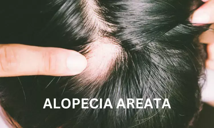 Combo of methotrexate and low dose prednisone benefits alopecia areata patients: JAMA