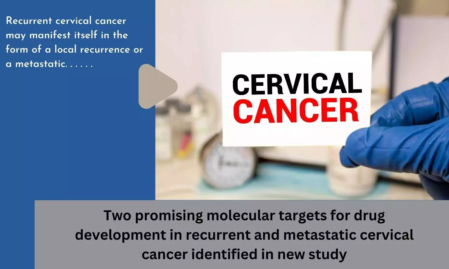 Two promising molecular targets for drug development in recurrent and metastatic cervical cancer identified in new study