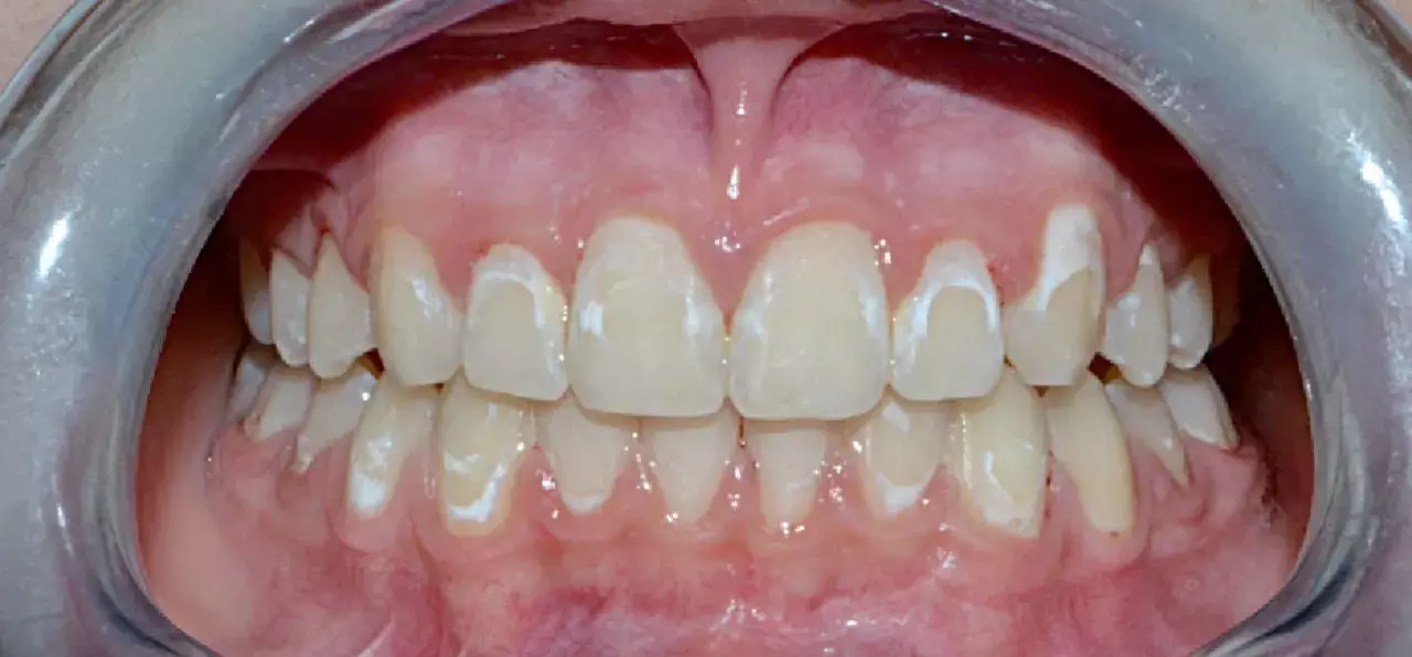 Resin Infiltration Effectively Masks Initial Caries Lesions After Orthodontic Treatment
