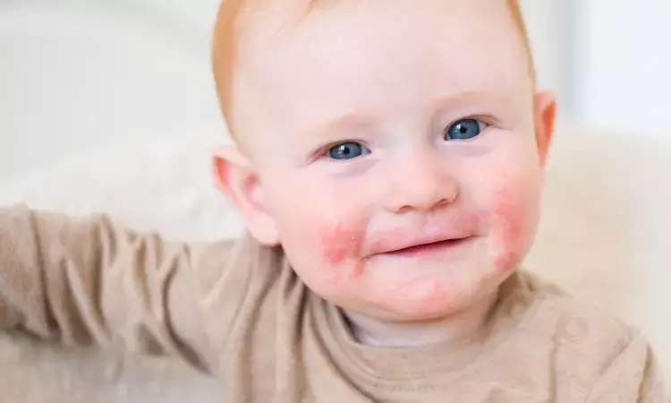Early management of atopic dermatitis can reduce food allergy in infants