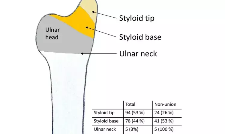 Concomitant Ulnar Styloid Fractures can be left untreated while treating Distal Radius Fractures with surgical fixation