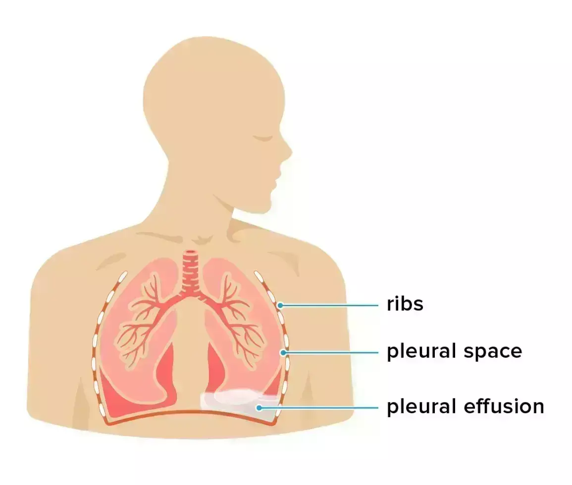 Pleural effusion linked to increased short-term mortality in patients with pulmonary embolism