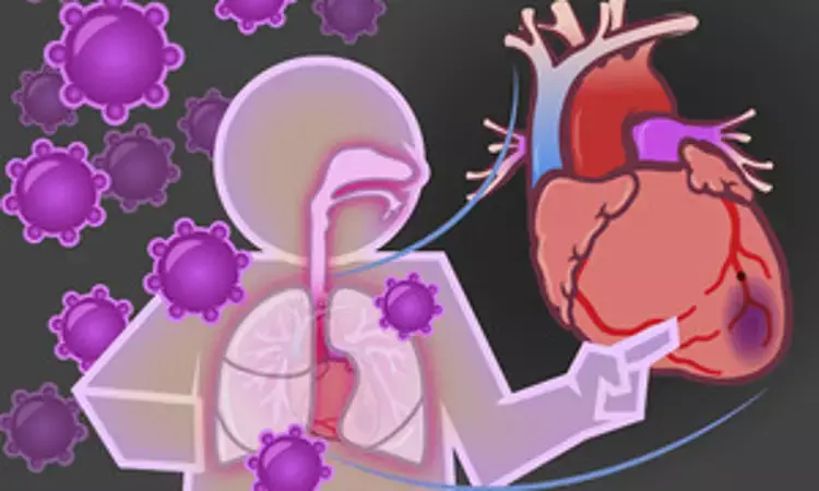 Influenza virus infection may increase risk of acute myocardial infarction