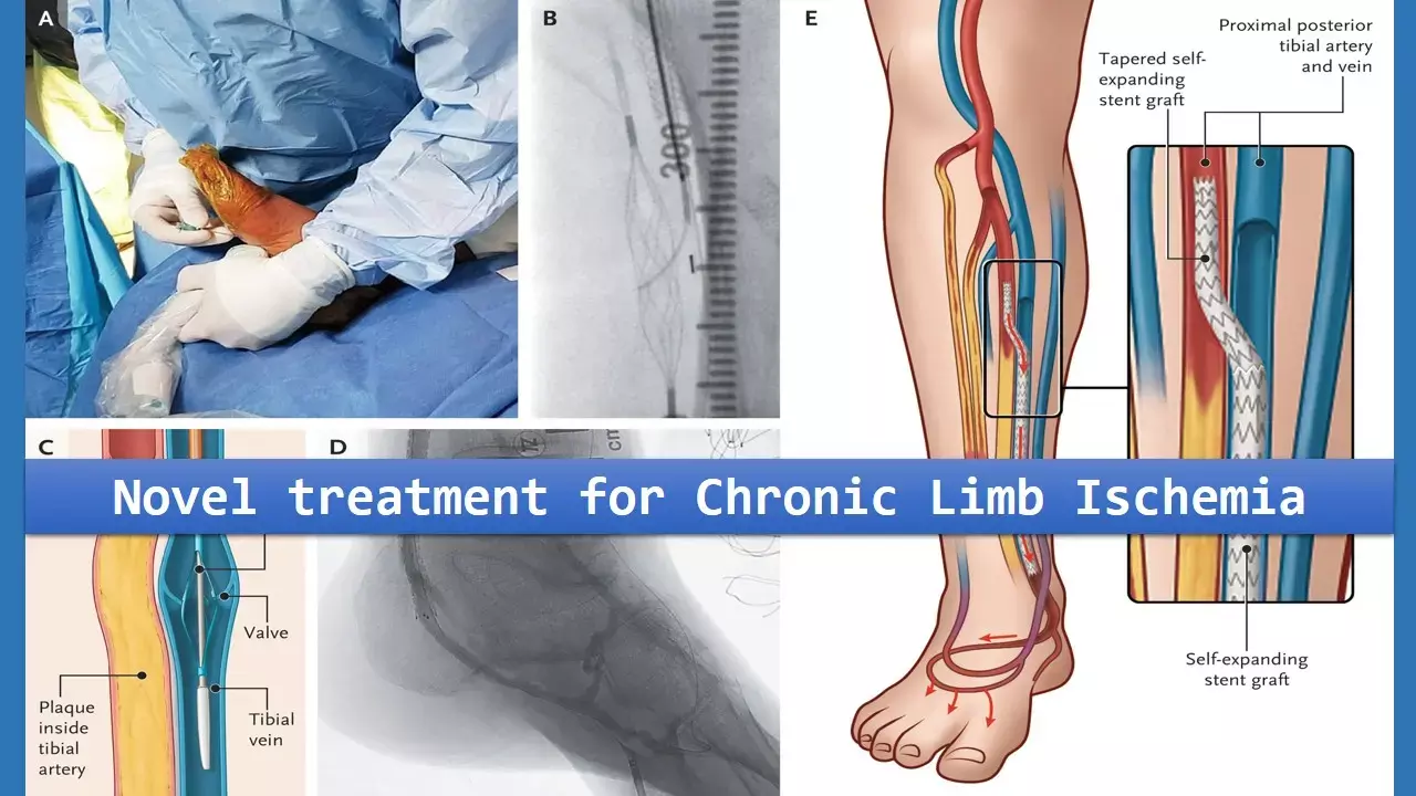 Novel endovascular technique may prevent amputation in no-option limb ischemia patients: NEJM study