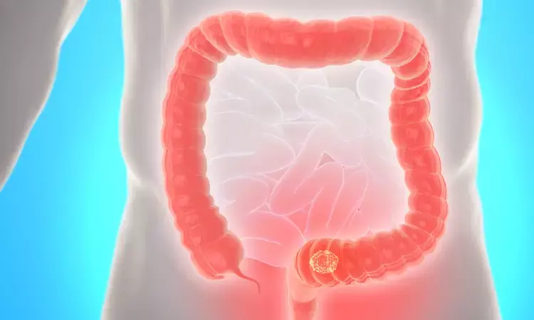 In Utero exposure to Dicyclomine tied to increased risk of colorectal cancer among offsprings