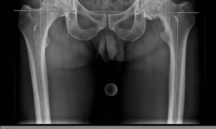 AI-powered applications are reliable alternative to manual evaluation of pelvic radiographs