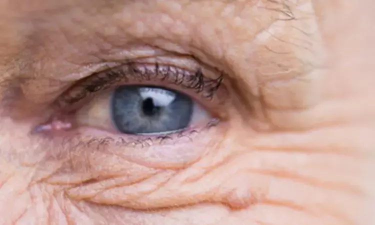 Alzheimers Medications Reduce Age-Related Macular Degeneration Risk: JAMA