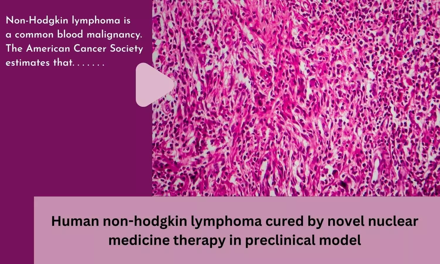 Human non-hodgkin lymphoma cured by novel nuclear medicine therapy in preclinical model