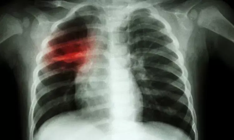 Nintedanib and prednisone taper combo improves pulmonary exacerbations in radiation pneumonitis