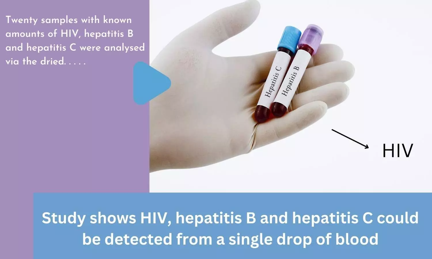 Study shows HIV, hepatitis B and hepatitis C could be detected from a single drop of blood