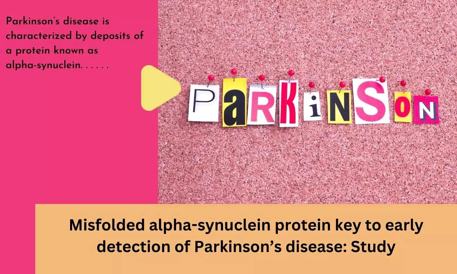 Misfolded alpha-synuclein protein key to early detection of Parkinsons disease: Study