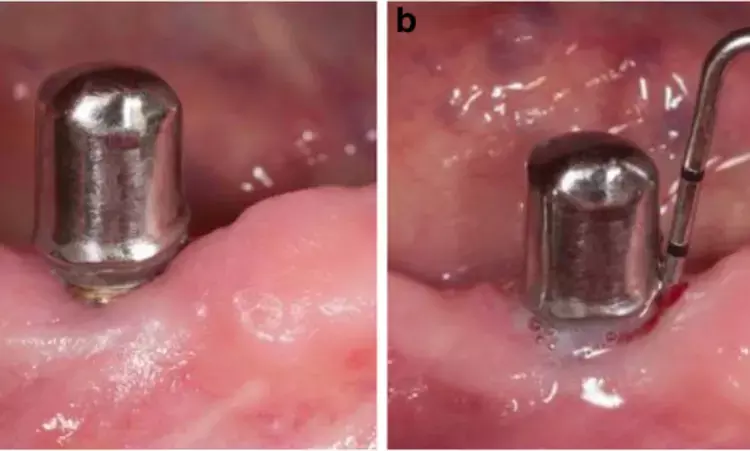 Ultrasonography useful Noninvasive Method for Assessing Keratinized Mucosal Width at dental Implant Sites
