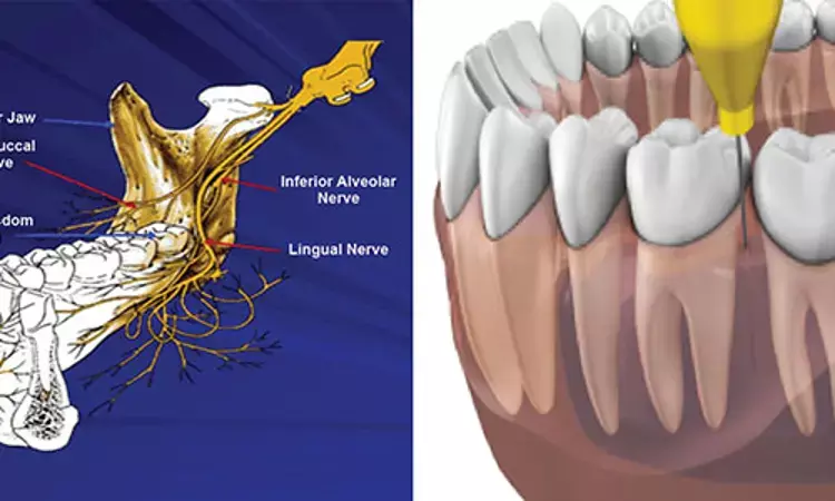 Preoperative steroids enhance anesthetic effect of inferior alveolar nerve block in mandibular molars with irreversible pulpitis