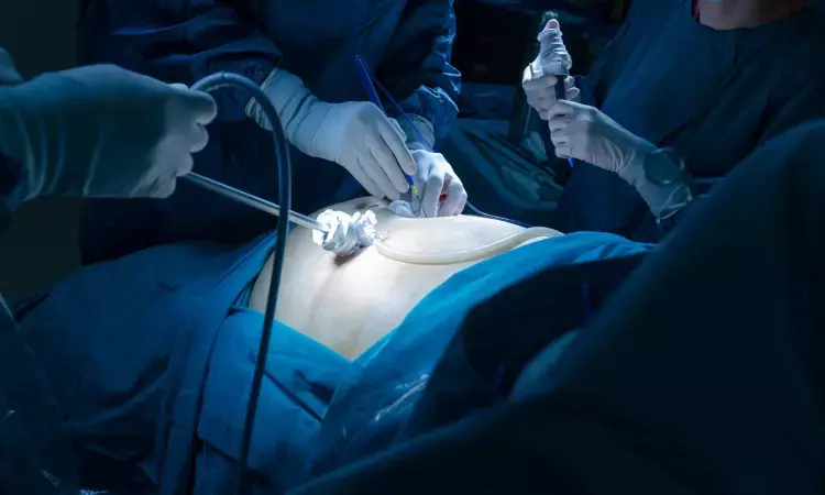 Single-Incision Laparoscopic Surgery effective for Gastrointestinal Stromal Tumor