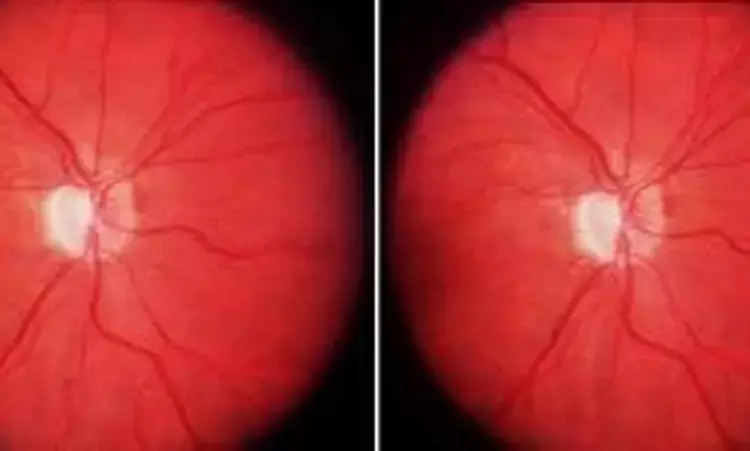 Papillary vitreous detachment linked to pathogenesis of non-arteritic anterior ischaemic optic neuropathy