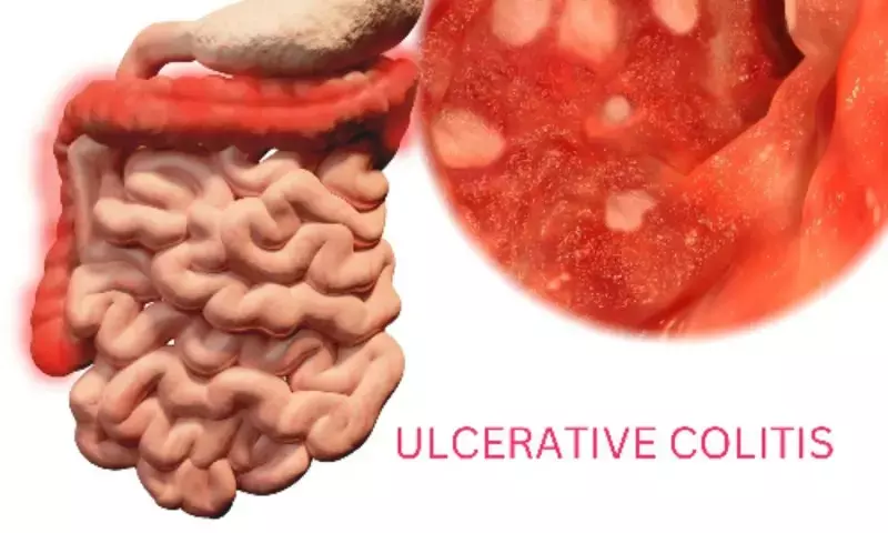 Ulcerative colitis - The Lancet