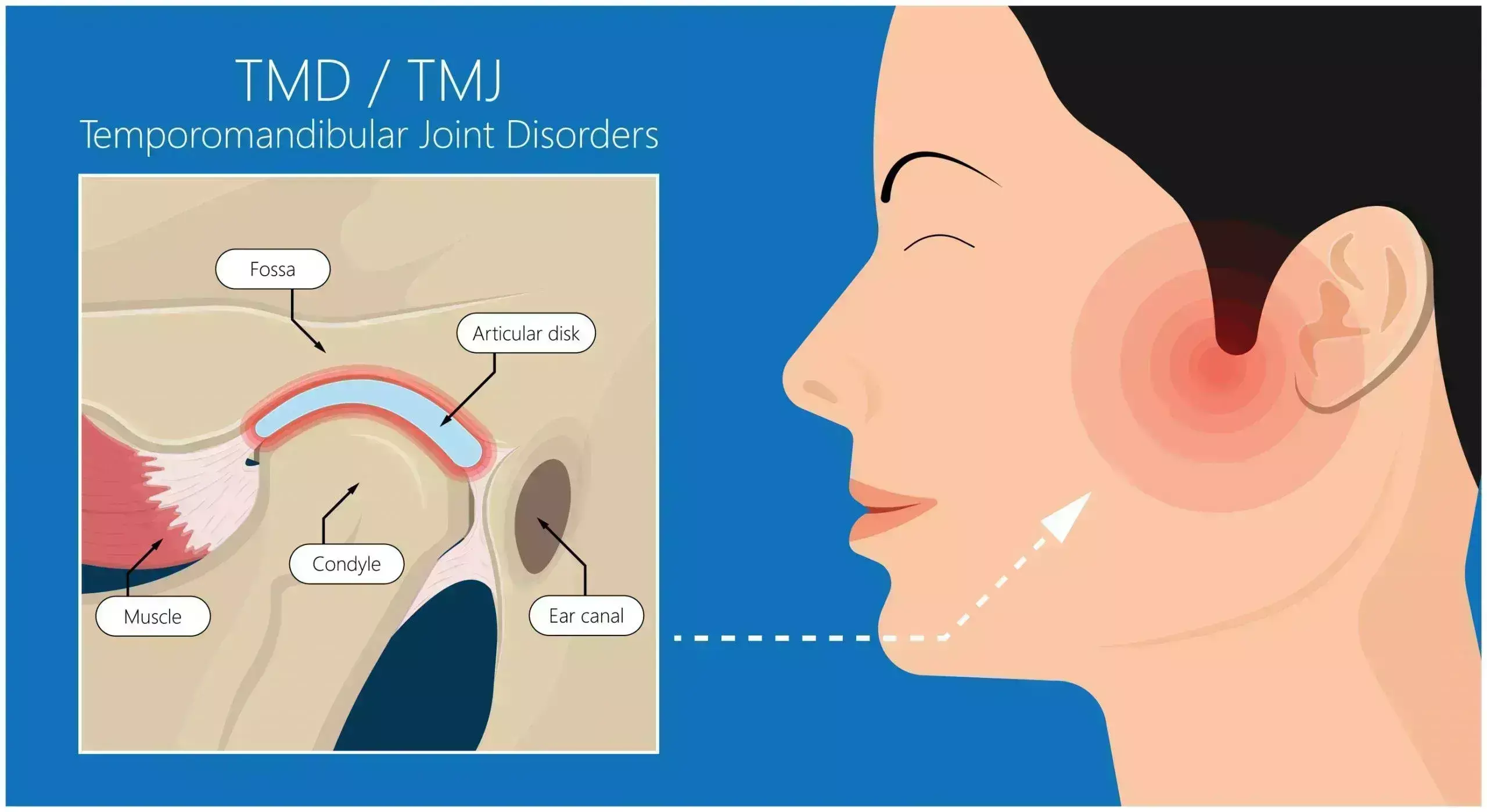 Patients With Traumatic Brain Injury More prone to Experience TMJ Dysfunction