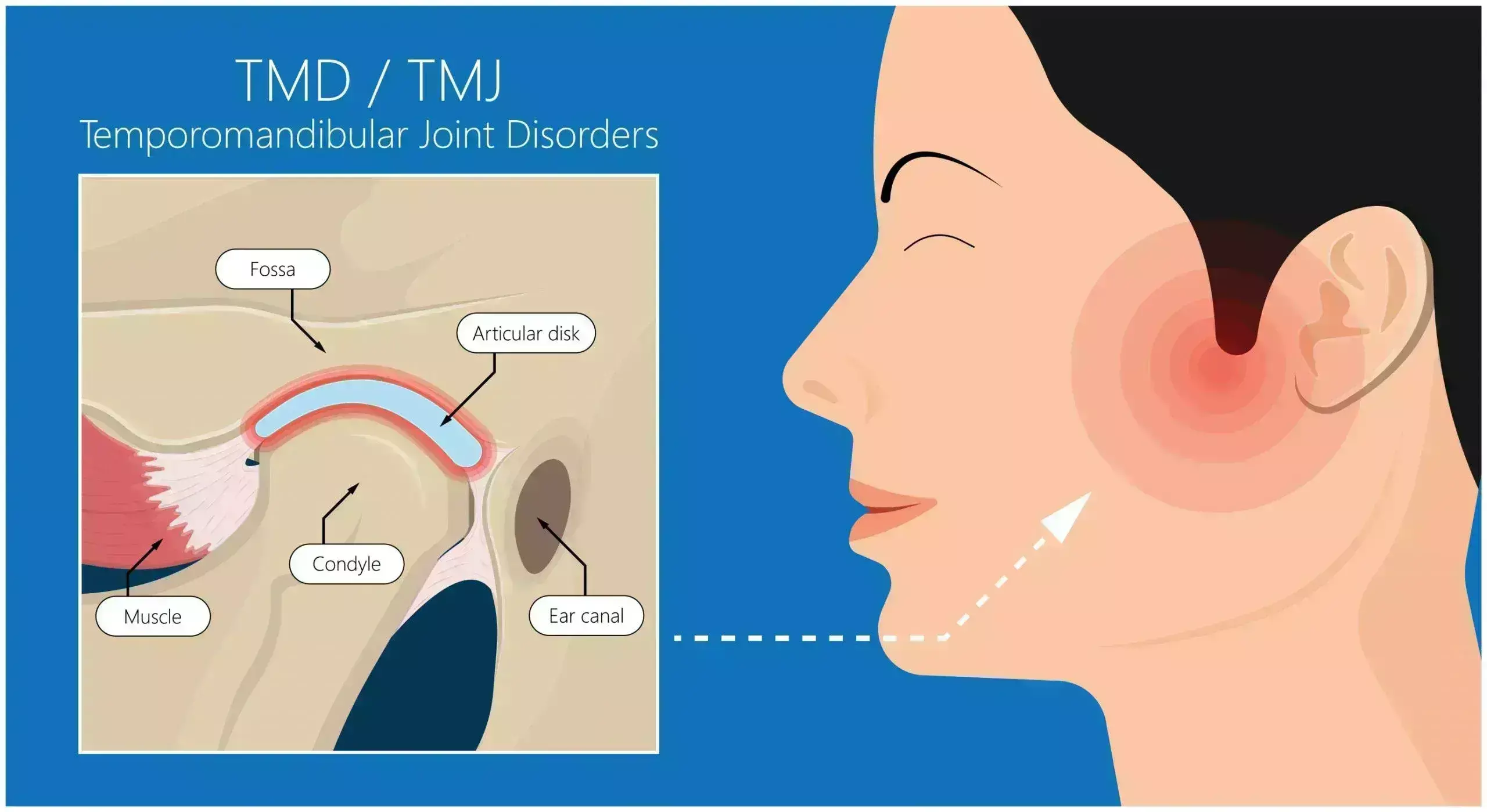 Patients With Traumatic Brain Injury More prone to Experience TMJ Dysfunction