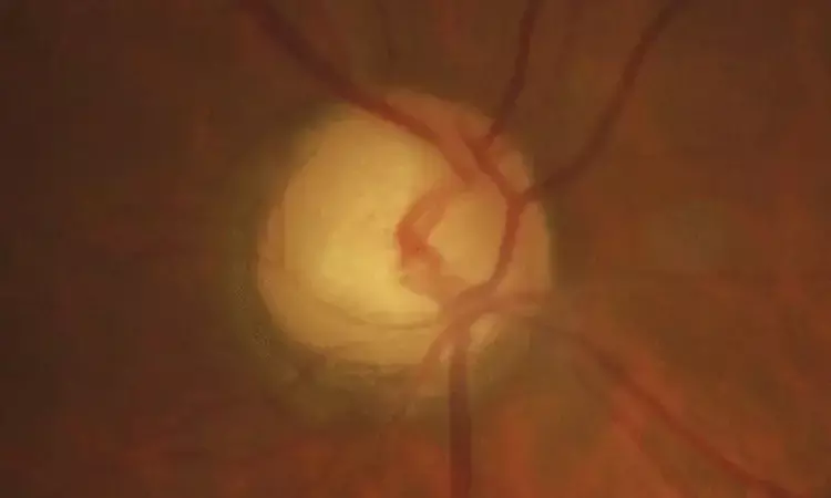 Calcium channel blockers represent an important risk factor for glaucoma
