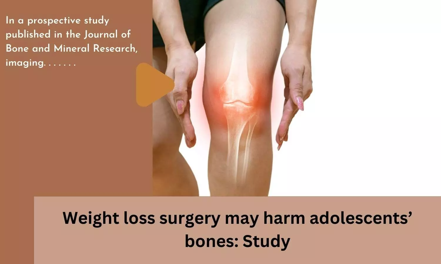 Weight loss surgery may harm adolescents bones: Study