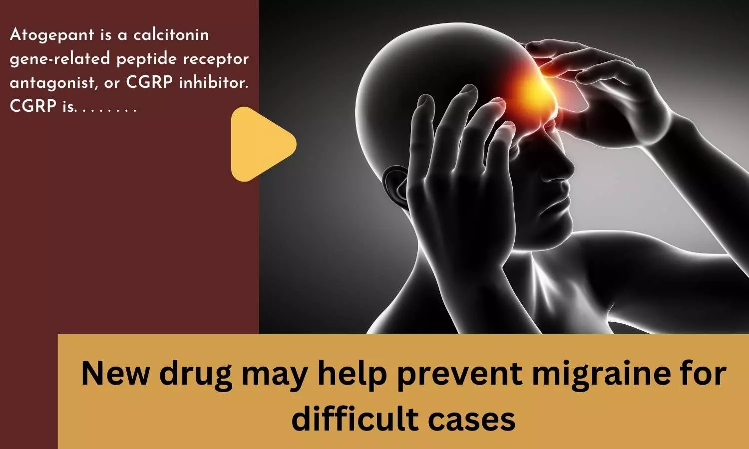 New drug may help prevent migraine for difficult cases