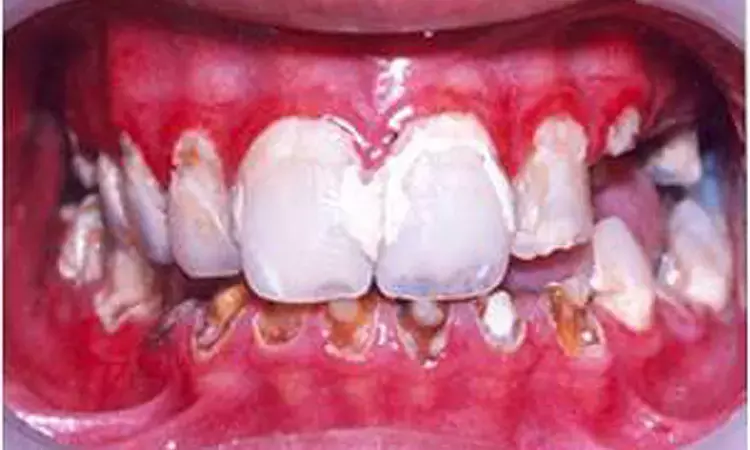 Anemia-related dental caries has highly negative impact on quality of life of children and parents