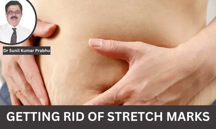 How To Get Rid Of Stretch Marks? - Dr Sunil Kumar Prabhu