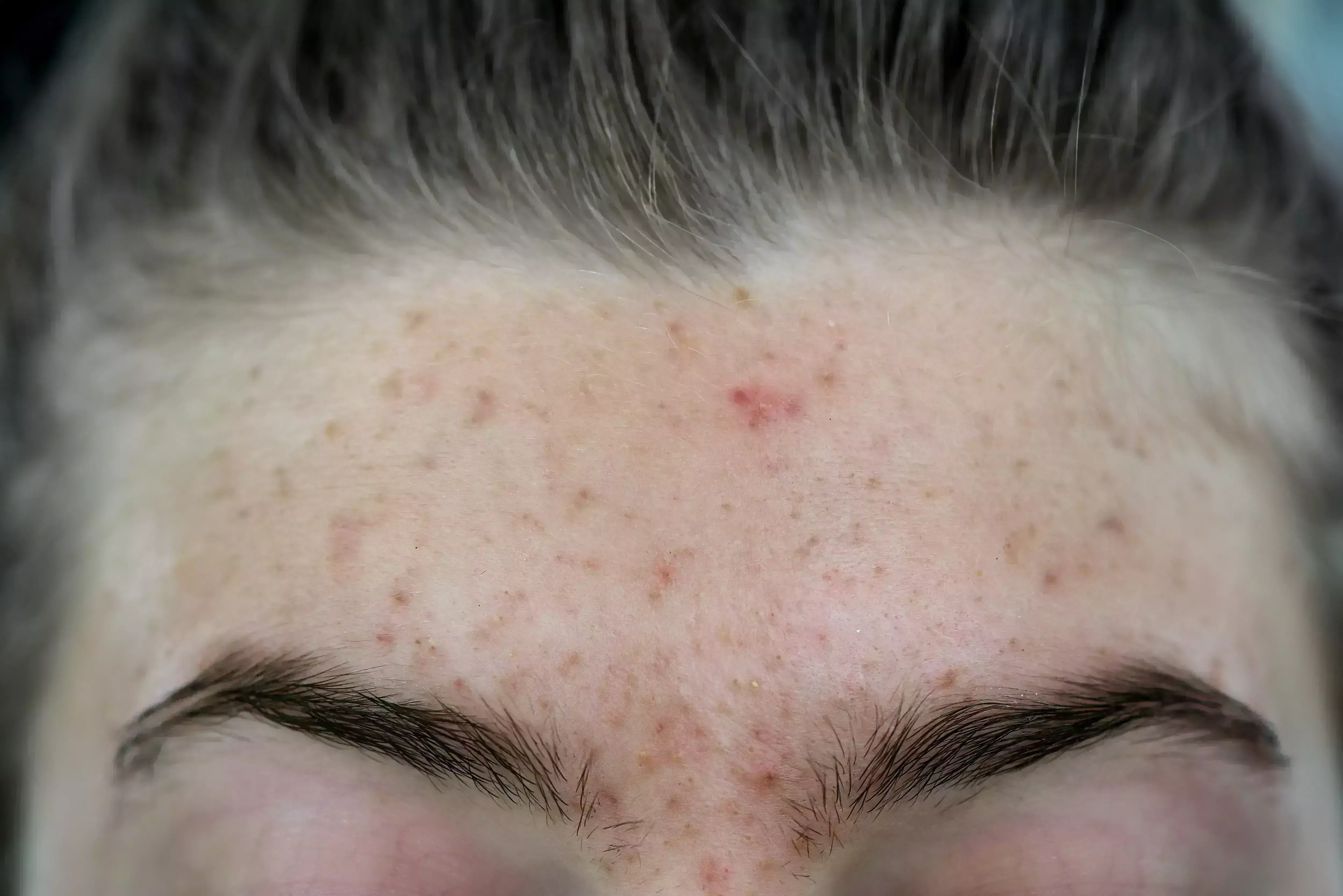 Tranexamic Acid Mesotherapy Effective for Post-Acne Erythema