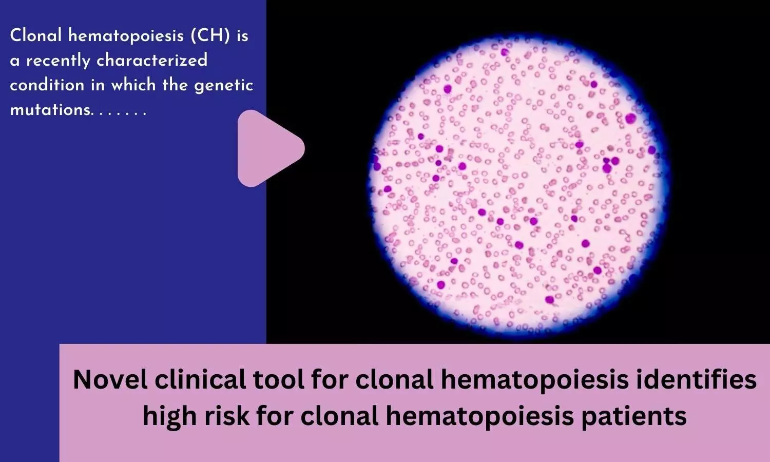 Novel clinical tool for clonal hematopoiesis identifies high risk for clonal hematopoiesis patients