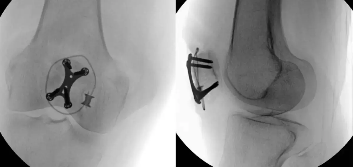 Plating of comminuted patellar fractures safe and viable treatment strategy