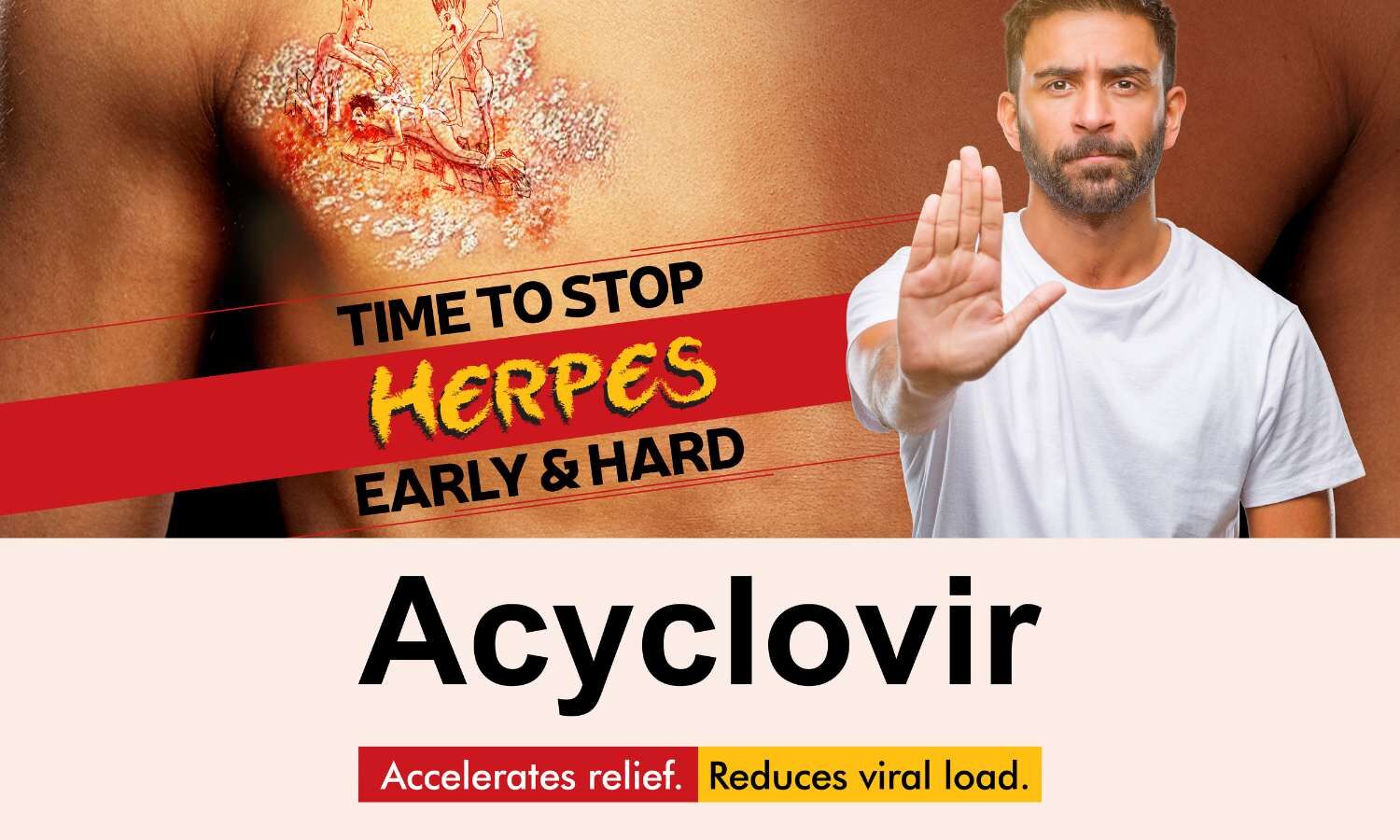 managing-genital-herpes-with-acyclovir-an-indian-experience