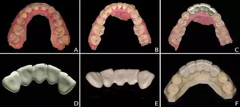Silicone-Based Soft Liners Outperform Acrylic-Based Soft Liners in Maximum Biting Force