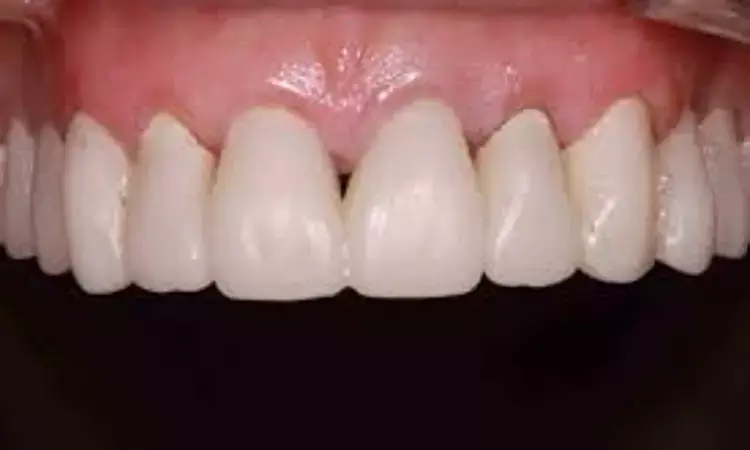 Use of more translucent cement can produce smaller color interference on  aesthetic outcome of interim restorations