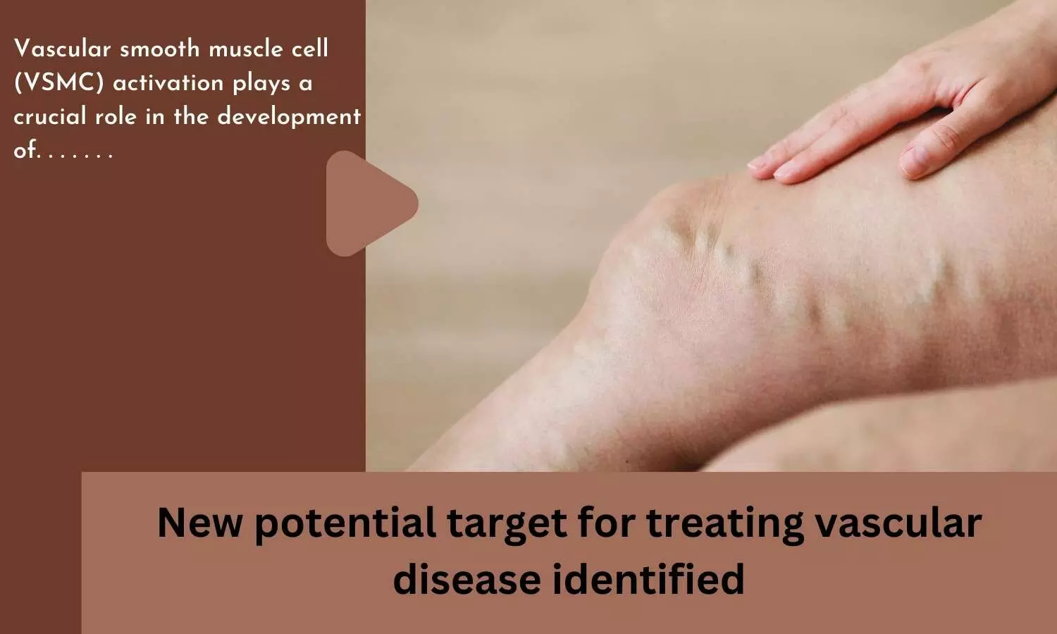 New potential target for treating vascular disease identified