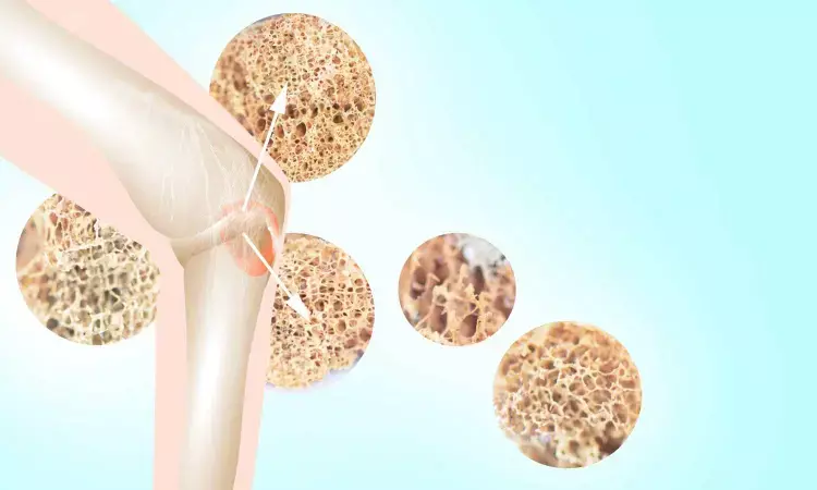 A quick, inexpensive test for detecting osteoporosis risk developed