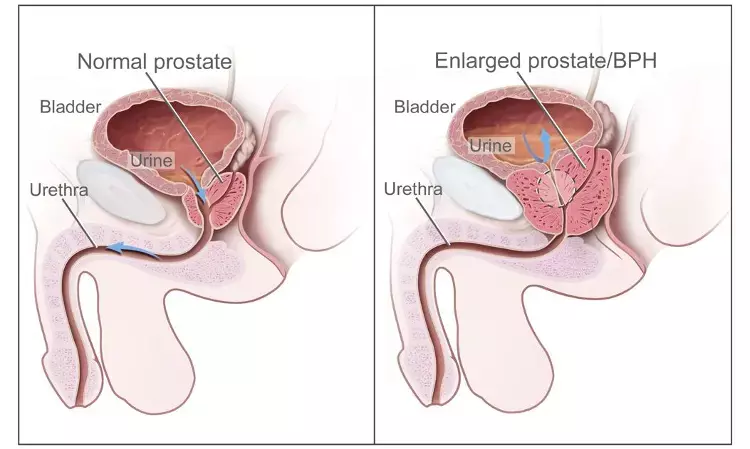 Prostate-specific antigen-based prostate cancer screening reduces metastasis and mortality