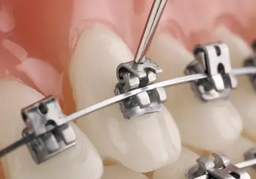Self-Ligating Brackets fail to Reduce Pain Compared to Conventional Orthodontic Appliances in Patients With Class I Malocclusion