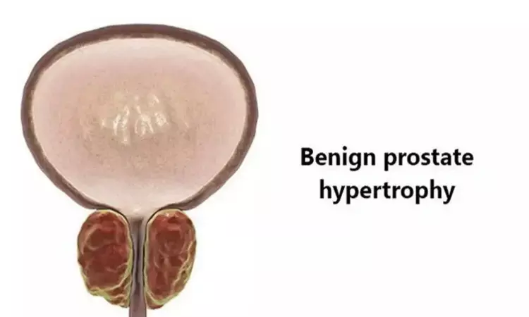 Rezum safe minimally invasive treatment for lower urinary tract symptoms due to benign prostatic obstruction