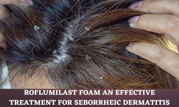 Roflumilast Foam Found Safe and Effective for Seborrheic Dermatitis Treatment: JAMA