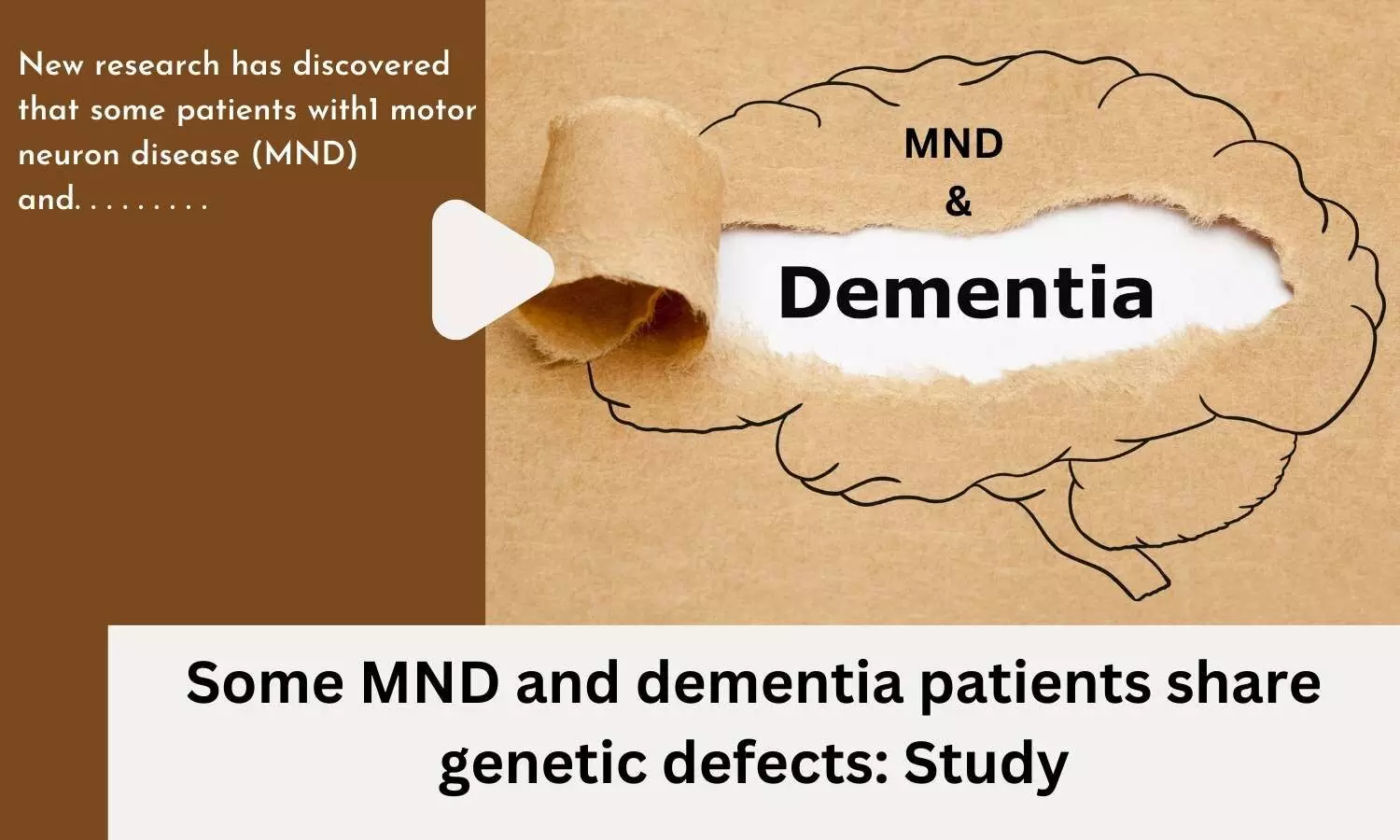 Some MND and dementia patients share genetic defects: Study