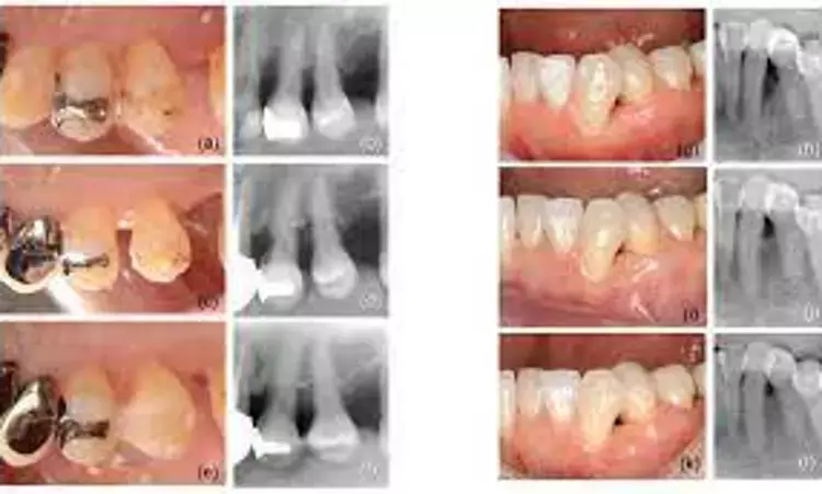 Composite outcome measures may help predict clinical outcomes after periodontal regenerative therapy