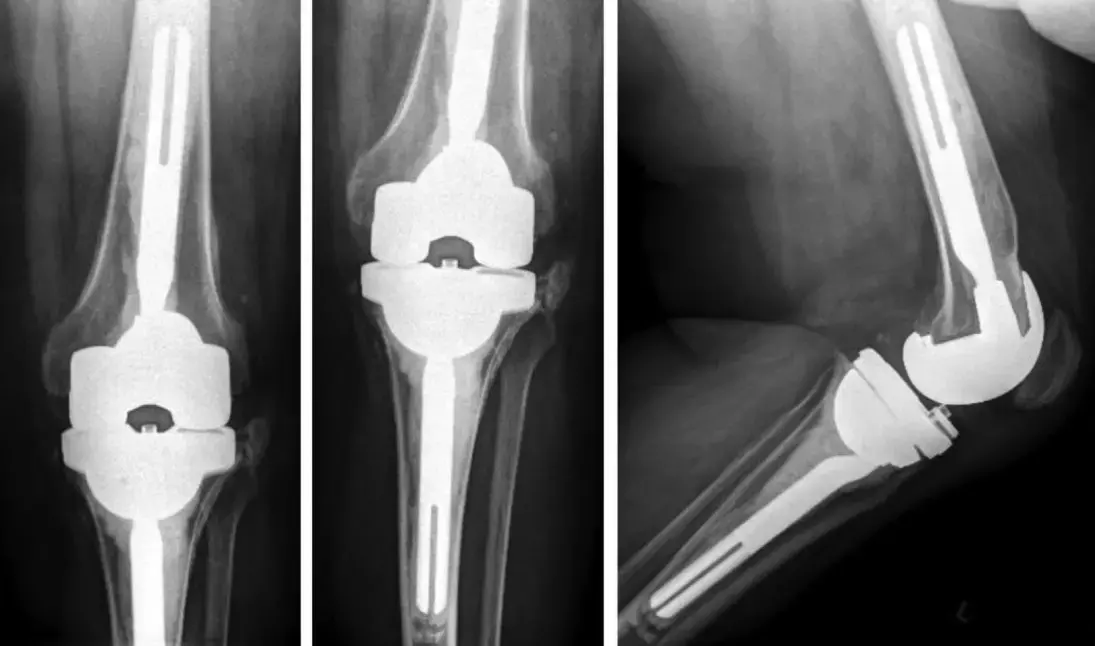 Revision Acetabular Shell utilized as Tibial Cone in Revision Total Knee Arthroplasty: a case report