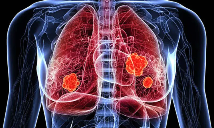 Evidence of lasting lung damage, impaired lung function found in TB patients even after successful treatment: Study