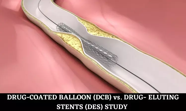 Drug-Coated Balloon Angioplasty Safe Alternative to Stent for Heart Attack Treatment: JACC