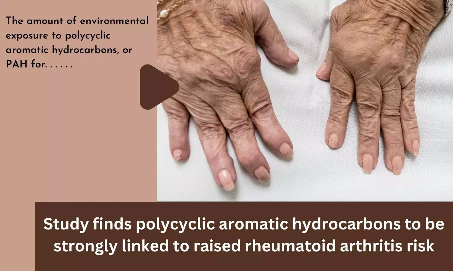 Study finds polycyclic aromatic hydrocarbons to be strongly linked to raised rheumatoid arthritis risk