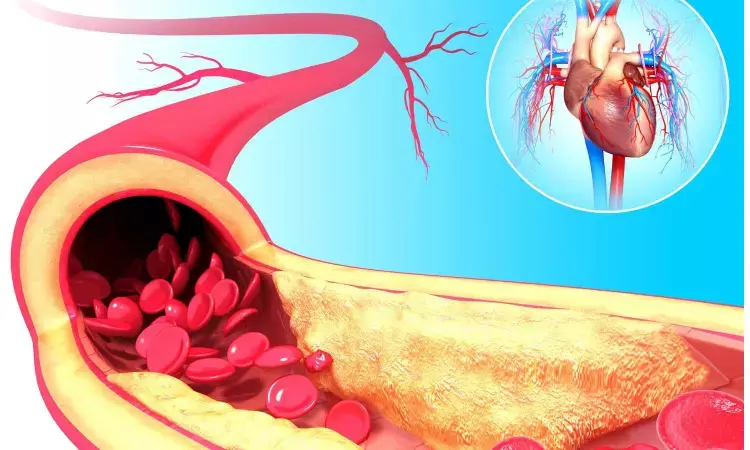Postmenopausal women with clogged arteries at greater risk of heart attacks than men