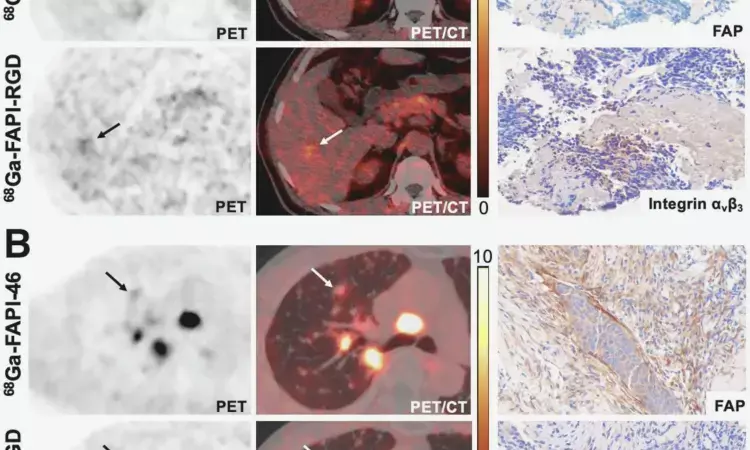 New PET radiotracer shows potential for cancer imaging, study shows